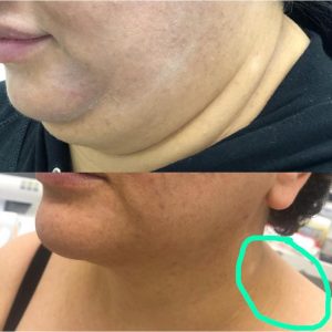 Lipo Lax results double chin