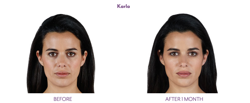 Juvederm Volift before and after