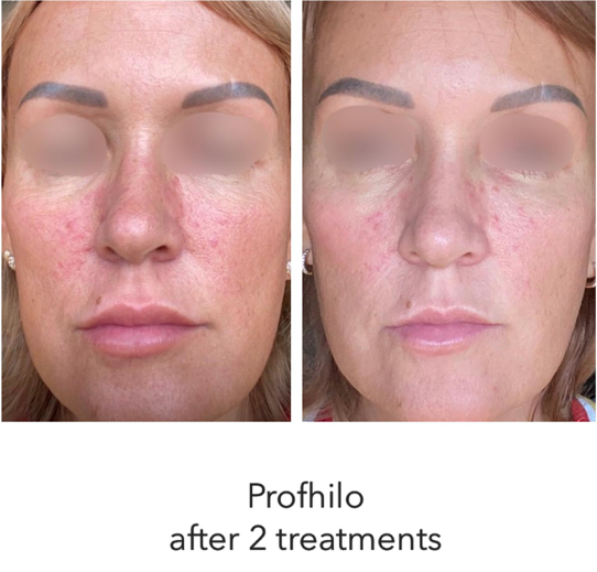 Profhilo: All you need to know about bioremodelling