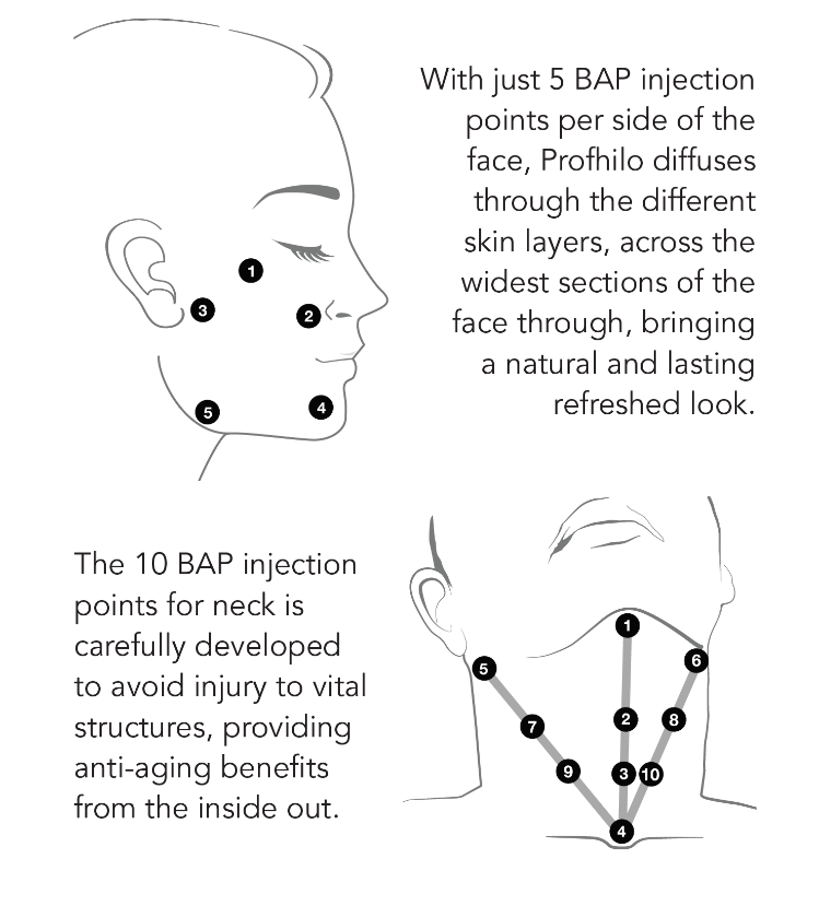 Profhilo treatment protocol