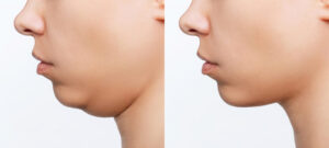 Mesotharapy for double chin