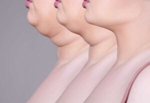 Mesotharapy for double chin