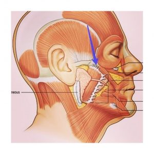 Cheeks and cheekbone correction techniques